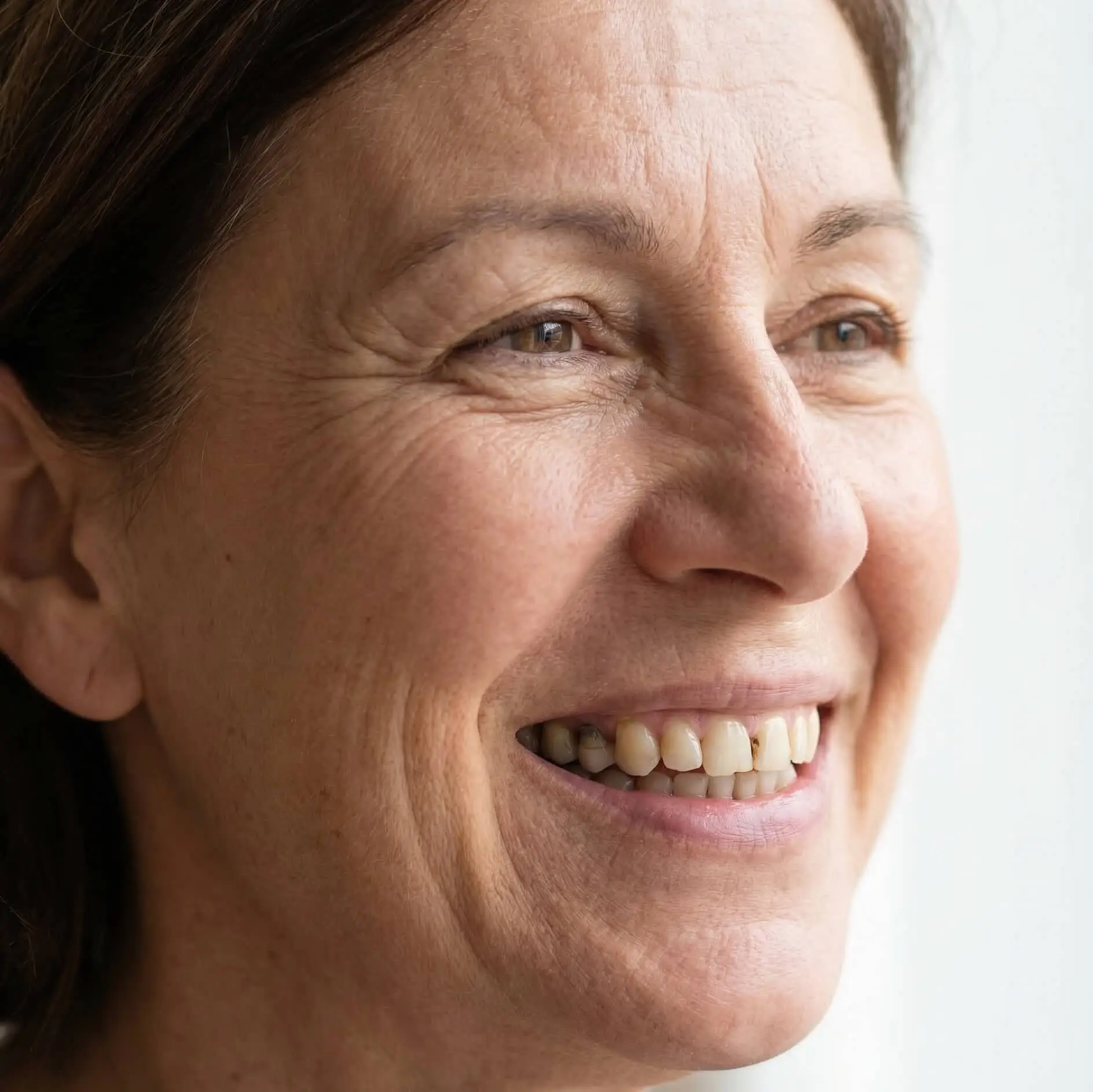 Before Smile Transformation at Harmoni Dental