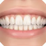 Composite Bonding