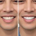 Teeth Whitening