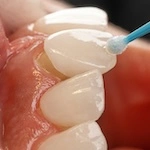 Veneers